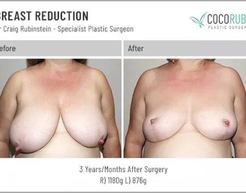 dr-craig-rubinstein-breast-reduction-611