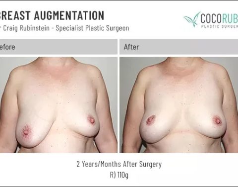 dr-craig-rubinstein-breast-reduction-651
