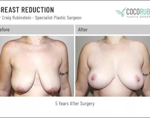 dr-craig-rubinstein-breast-reduction-671
