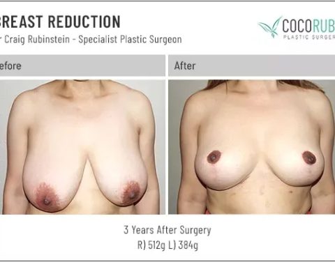 dr-craig-rubinstein-breast-reduction-701