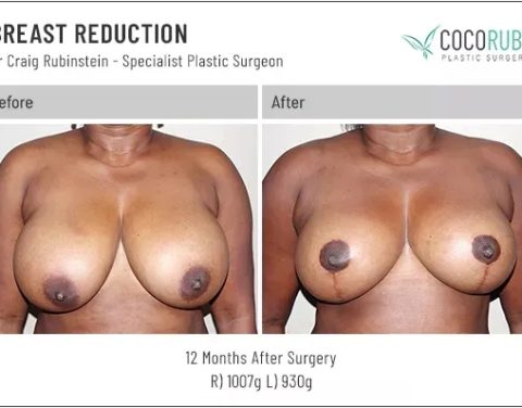 dr-craig-rubinstein-breast-reduction-731