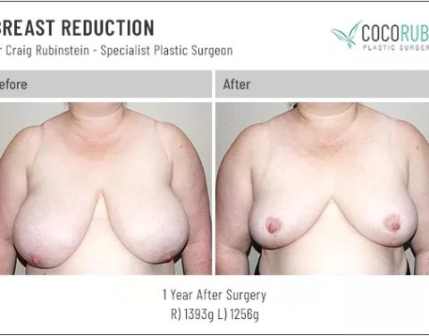 dr-craig-rubinstein-breast-reduction-751