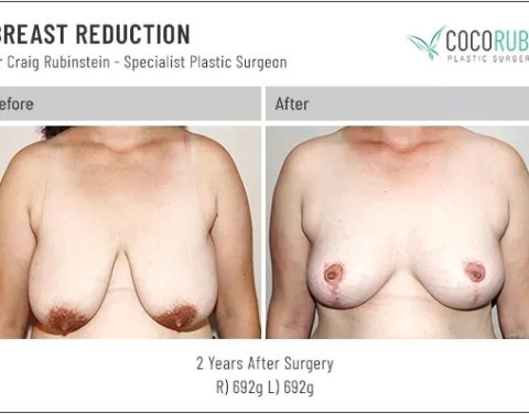 dr-craig-rubinstein-breast-reduction-771