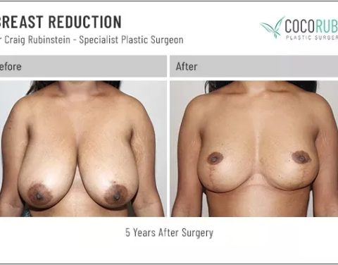 dr-craig-rubinstein-breast-reduction-81