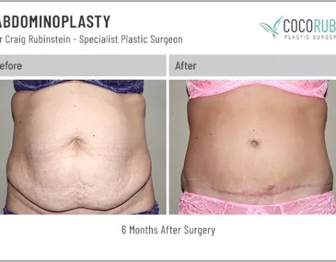 dr-craig-rubinstein-tummy-tuck-331