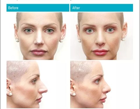 dr-stephen-kleid-rhinoplasty-2